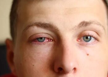 آشوب چشم:اسباب و تدارک