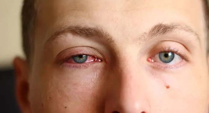 آشوب چشم:اسباب و تدارک